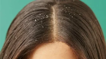 أسباب غير متوقعة.. طرق منزلية فعالة لإنهاء معاناة قشرة الشعر وحكة الرأس